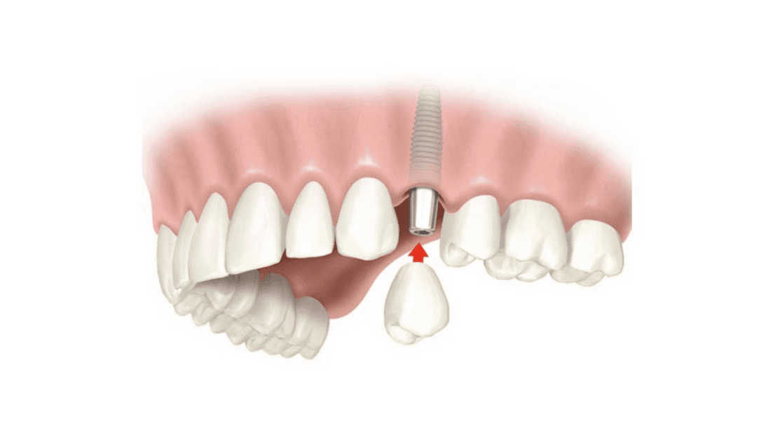 Implante Carga Imediata – Como Funciona?