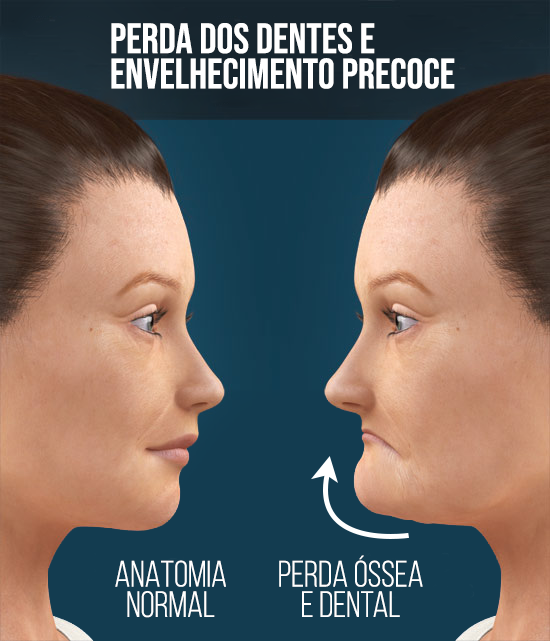 Você sabia que a perda dos dentes influência no envelhecimento precoce?